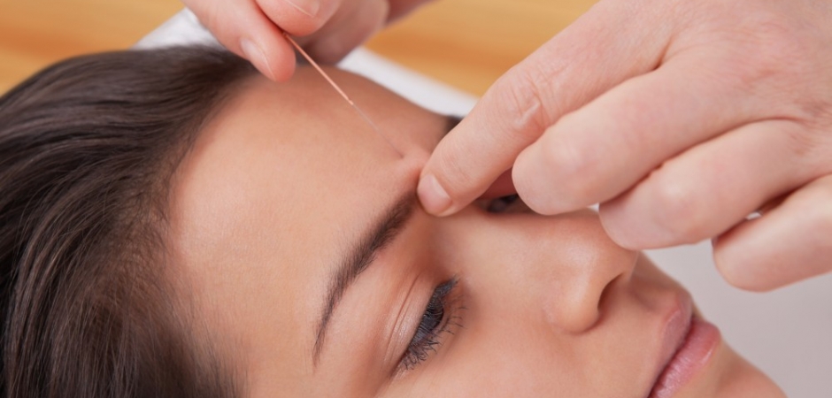 Acupuncture needles points treatment for headache